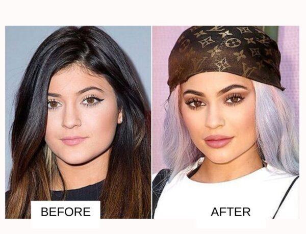 Kylie Jenner Before Surgery