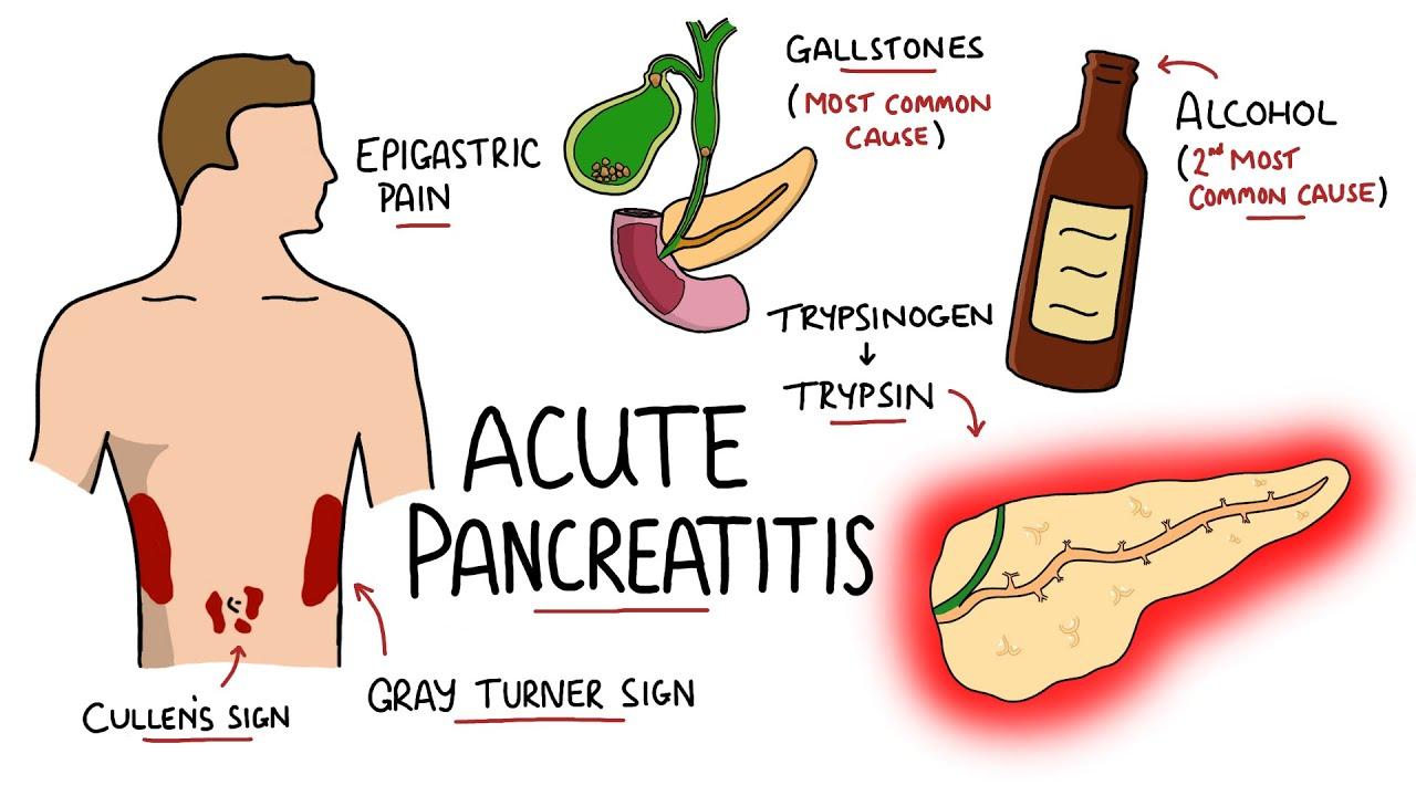 What is Pancreatitis